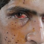 ‘80% pellet gun victims in Kashmir suffer from partial vision loss’, claims study