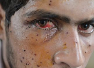 '80% pellet gun victims in Kashmir suffer from partial vision loss', claims study