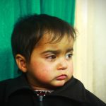 19-month old girl hit by pellets in Kashmir; may lose her right eye forever